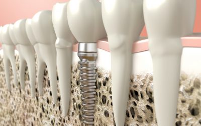 Dental Implants Are You A Good Candidate