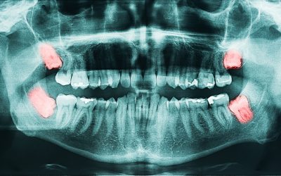 Common Wisdom Teeth Questions