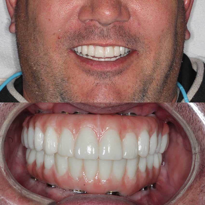 Dental Implants Free Consultation | Radiance Dental Camas WA Implant After 1 Cd - Dental Implants Free Consultation | Radiance Dental Camas WA
