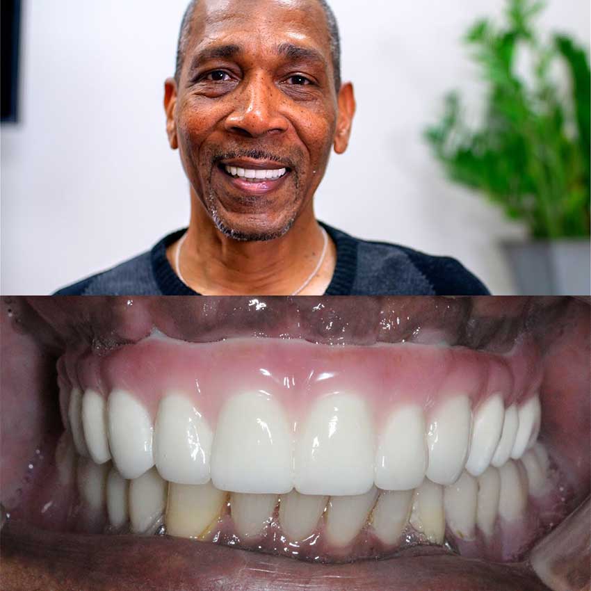 Dental Implants Free Consultation | Radiance Dental Camas WA Implant After 2 Cd - Dental Implants Free Consultation | Radiance Dental Camas WA