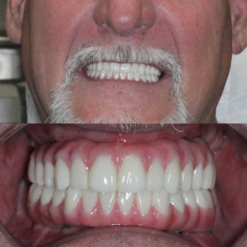 Dental Implants Free Consultation | Radiance Dental Camas WA Implant After 3 Cd - Dental Implants Free Consultation | Radiance Dental Camas WA