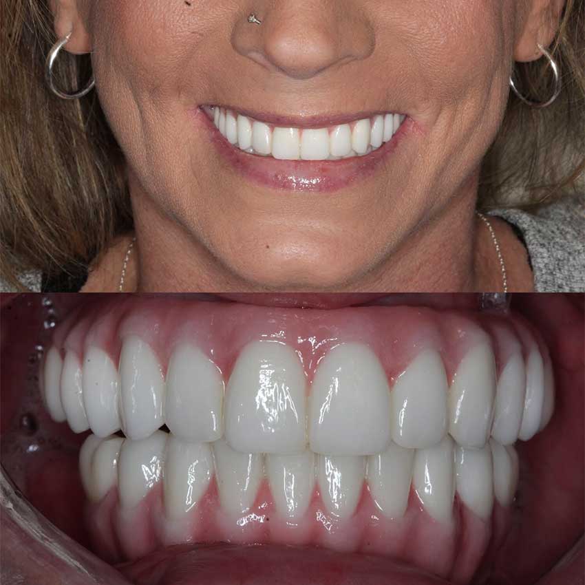Dental Implants Free Consultation | Radiance Dental Camas WA Implant After 4 Cd - Dental Implants Free Consultation | Radiance Dental Camas WA