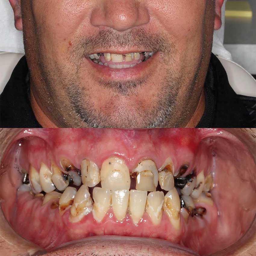 Dental Implants Free Consultation | Radiance Dental Camas WA Implant Before 1 Cd - Dental Implants Free Consultation | Radiance Dental Camas WA