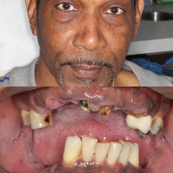 Dental Implants Free Consultation | Radiance Dental Camas WA Implant Before 2 D - Dental Implants Free Consultation | Radiance Dental Camas WA