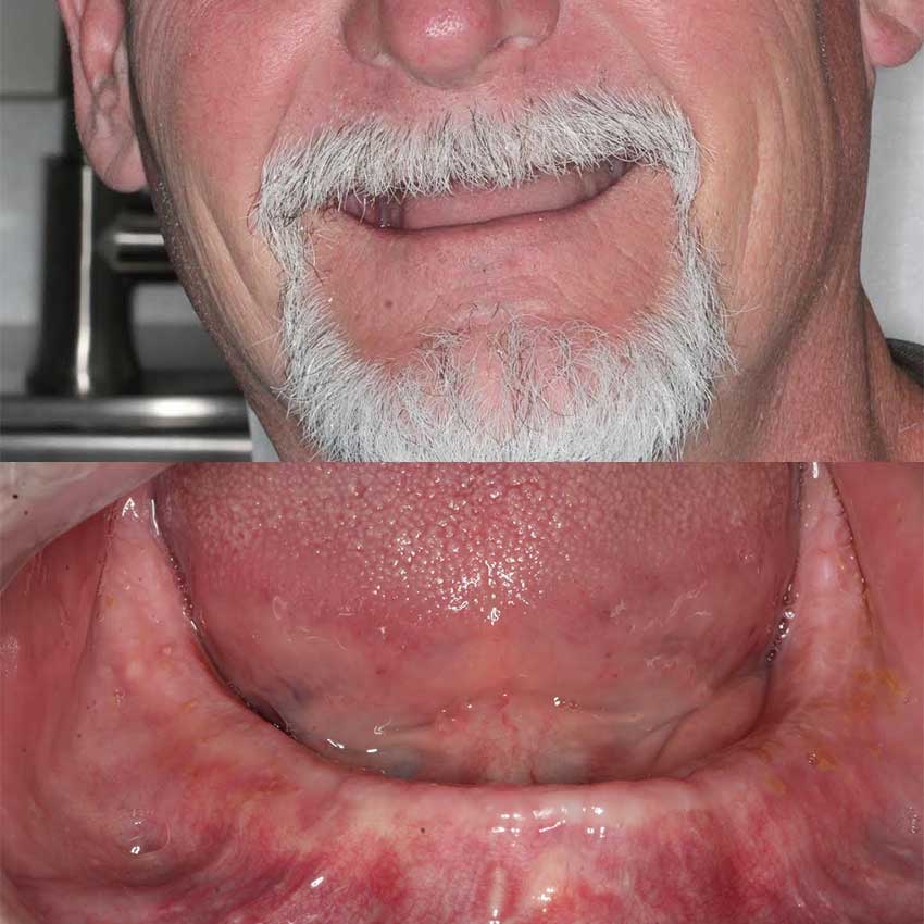 Dental Implants Free Consultation | Radiance Dental Camas WA Implant Before 3 Cd - Dental Implants Free Consultation | Radiance Dental Camas WA