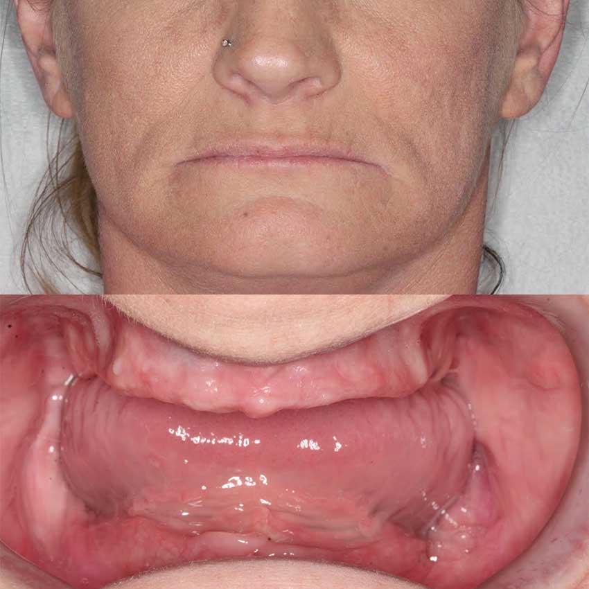 Dental Implants Free Consultation | Radiance Dental Camas WA Implant Before 4 Cd - Dental Implants Free Consultation | Radiance Dental Camas WA