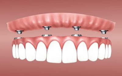 All on 4 Dental Implants vs Dentures