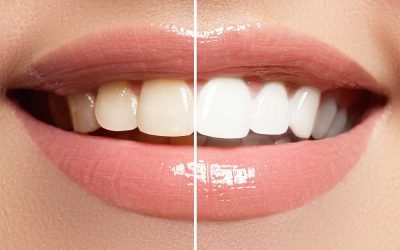 Professional Teeth Whitening vs. Home Teeth Whitening What You Need to Know