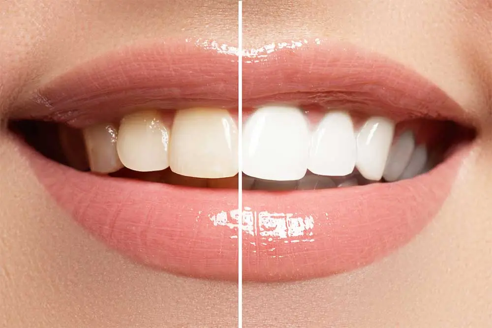 professional-teeth-whiteining-results
