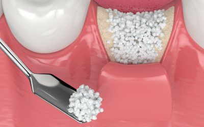 Do You Need a Bone Graft After Tooth Extraction?