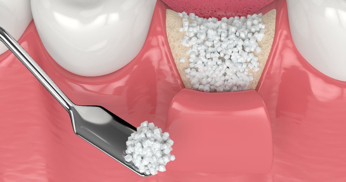 3d,Render,Of,Dental,Bone,Grafting,With,Bone,Biomaterial,Application