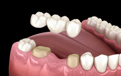 Dental Bridges in Vancouver WA for Aesthetic and Functional Solutions for a Complete Smile