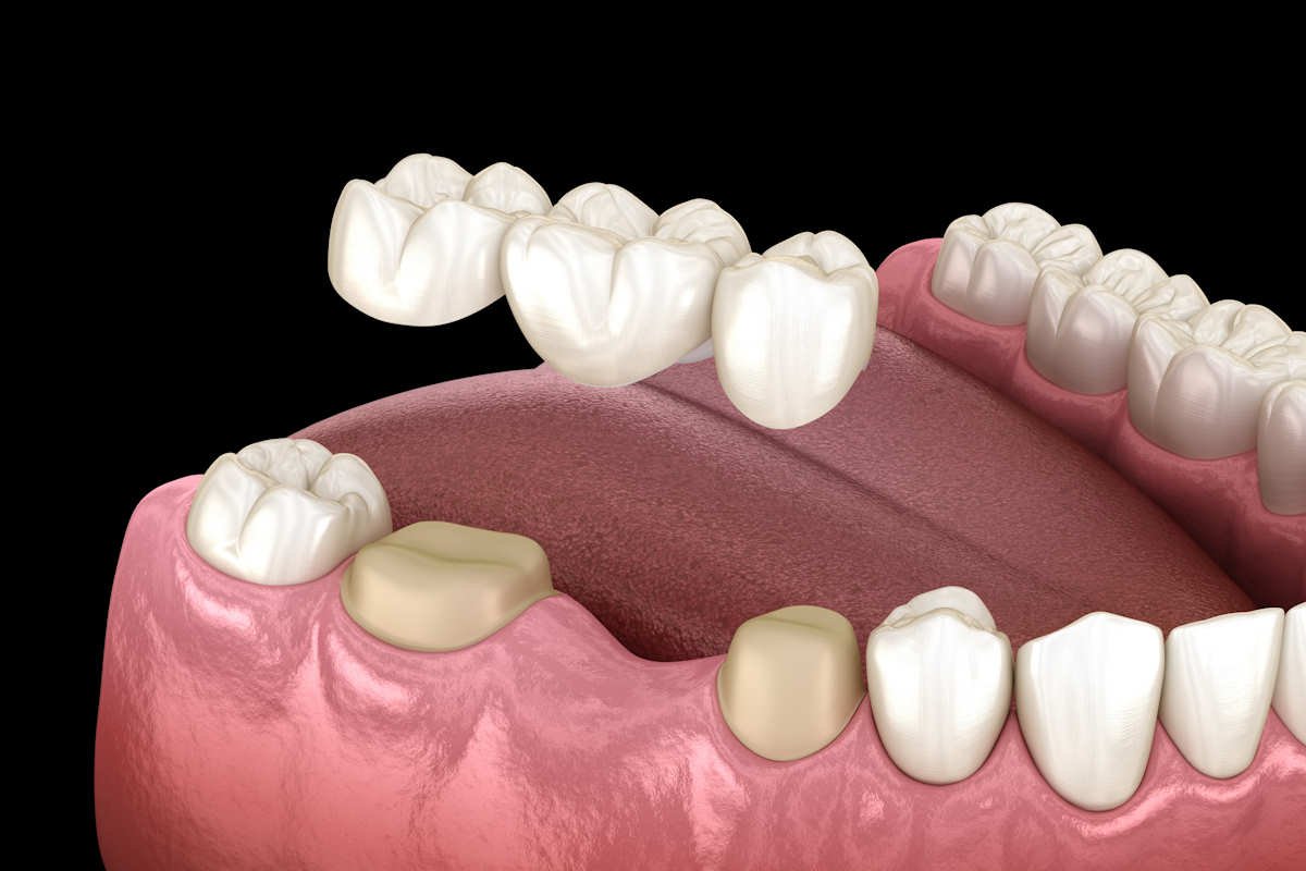 Dental,Bridge,Of,3,Teeth,Over,Molar,And,Premolar.,Medically Dental Bridges in Vancouver WA for Aesthetic and Functional Solutions