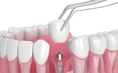 Fixed Dental Bridges vs. Dental Implants: Comprehensive Tooth Replacement Solutions