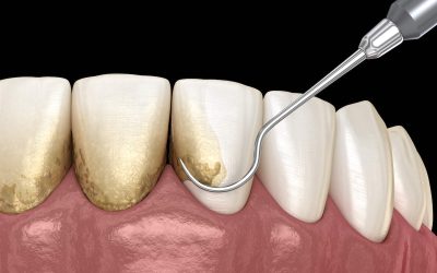 What Is Tooth Scaling and Root Planing? The Facts About Deep Cleaning
