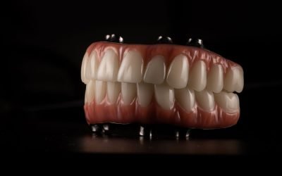 Full Mouth Dental Implants in Vancouver, WA: A Permanent Solution to Missing Teeth