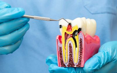 Will I Need a Crown After My Root Canal?