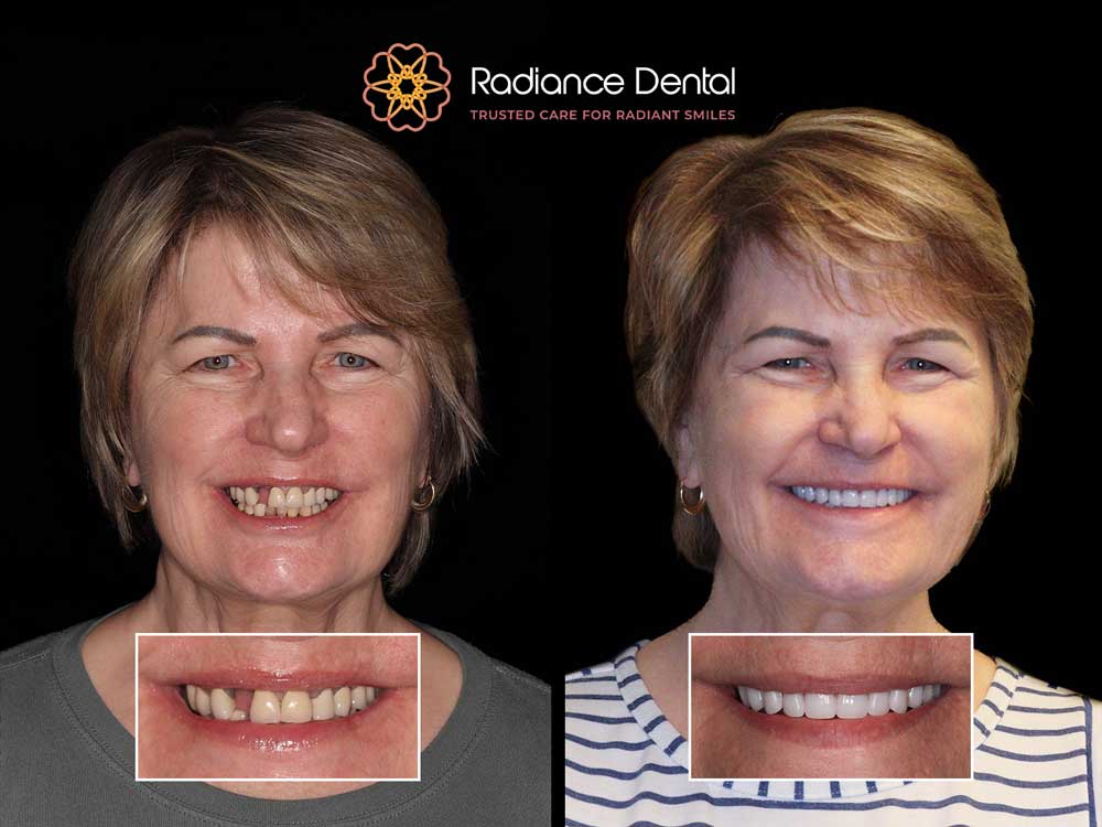 helen-upper-and-lower-snap-on-dentures-before-after