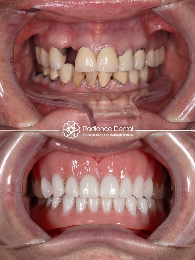 helen-upper-and-lower-snap-on-dentures-smile-before-after