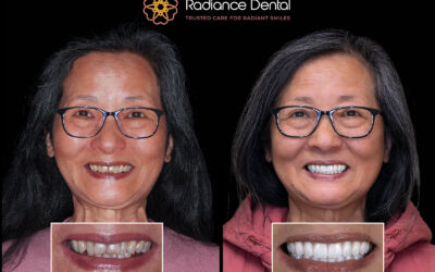 Same-Day Dental Implants in Camas: When They Work, When Traditional Is Smarter, and What You Leave With