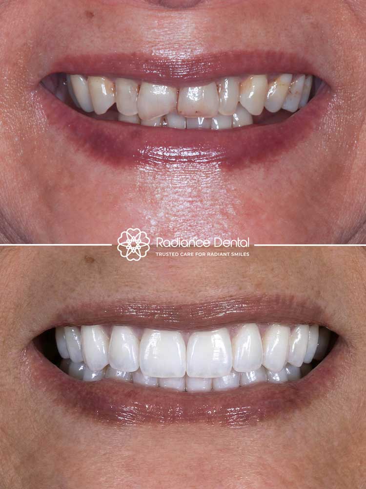 jialynnd-full-upper-arch-crowns-lower-implants-supported-fixed-hybrid-dentures-smile-before-after