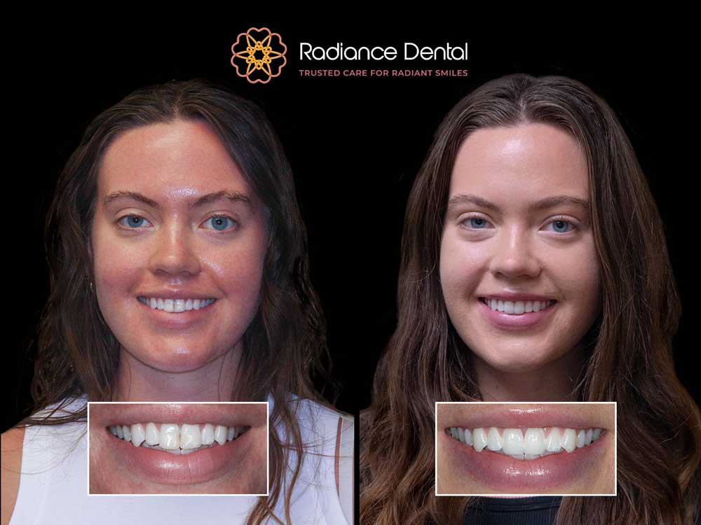 kellyc-two-front-veneers-before-after