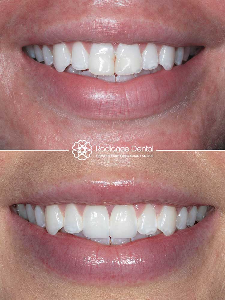 kellyc-two-front-veneers-smile-before-after