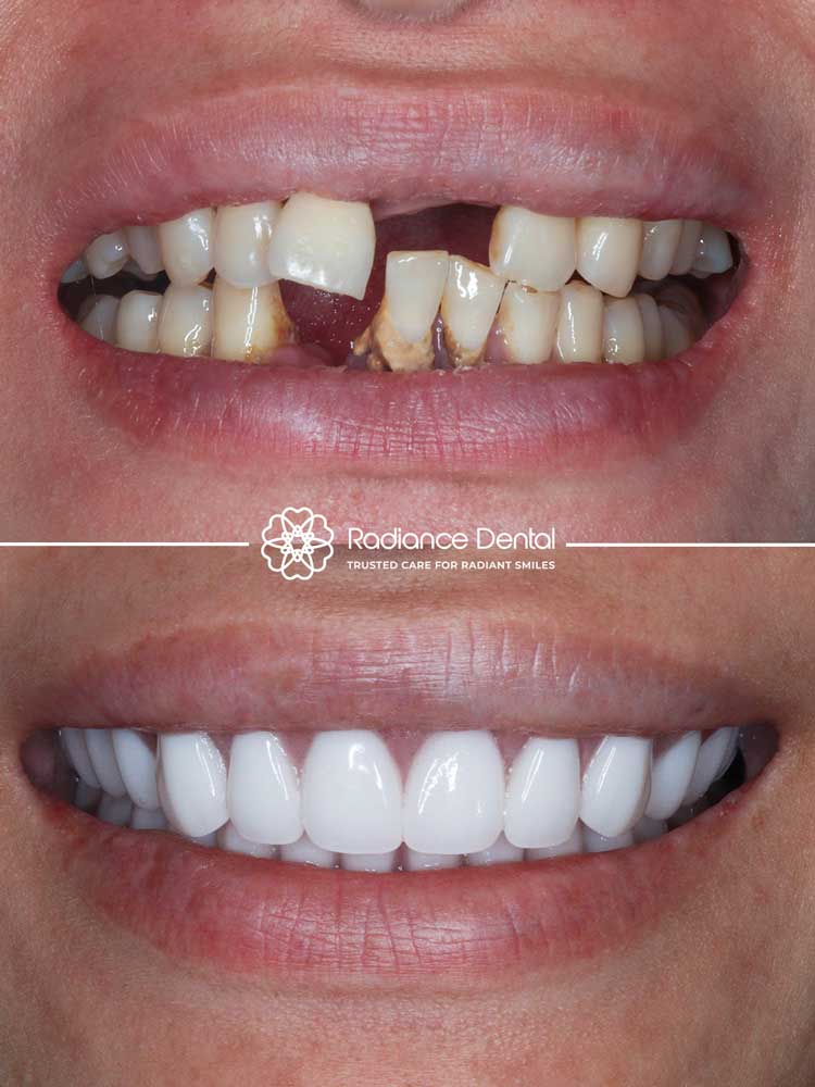 theena-4-upper-implants-6-lower-implants-supported-snap-on-dentures-smile-before-after