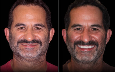 Teeth Grinding and Your Smile: Signs of Bruxism and Night Guard Options in Camas
