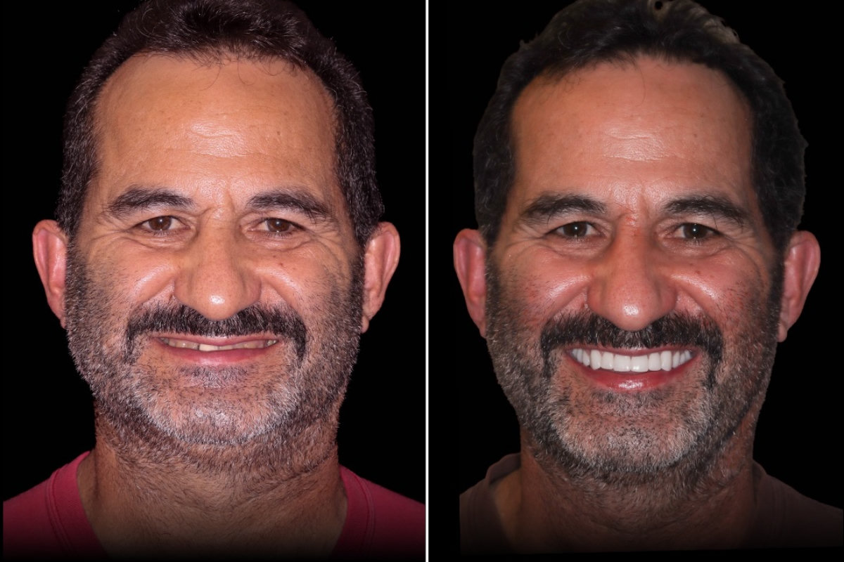 radiance-dental-bruxism-case