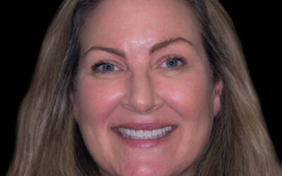 Veneers vs. Invisalign: Which Fixes a Crooked or Gapped Smile in Camas?